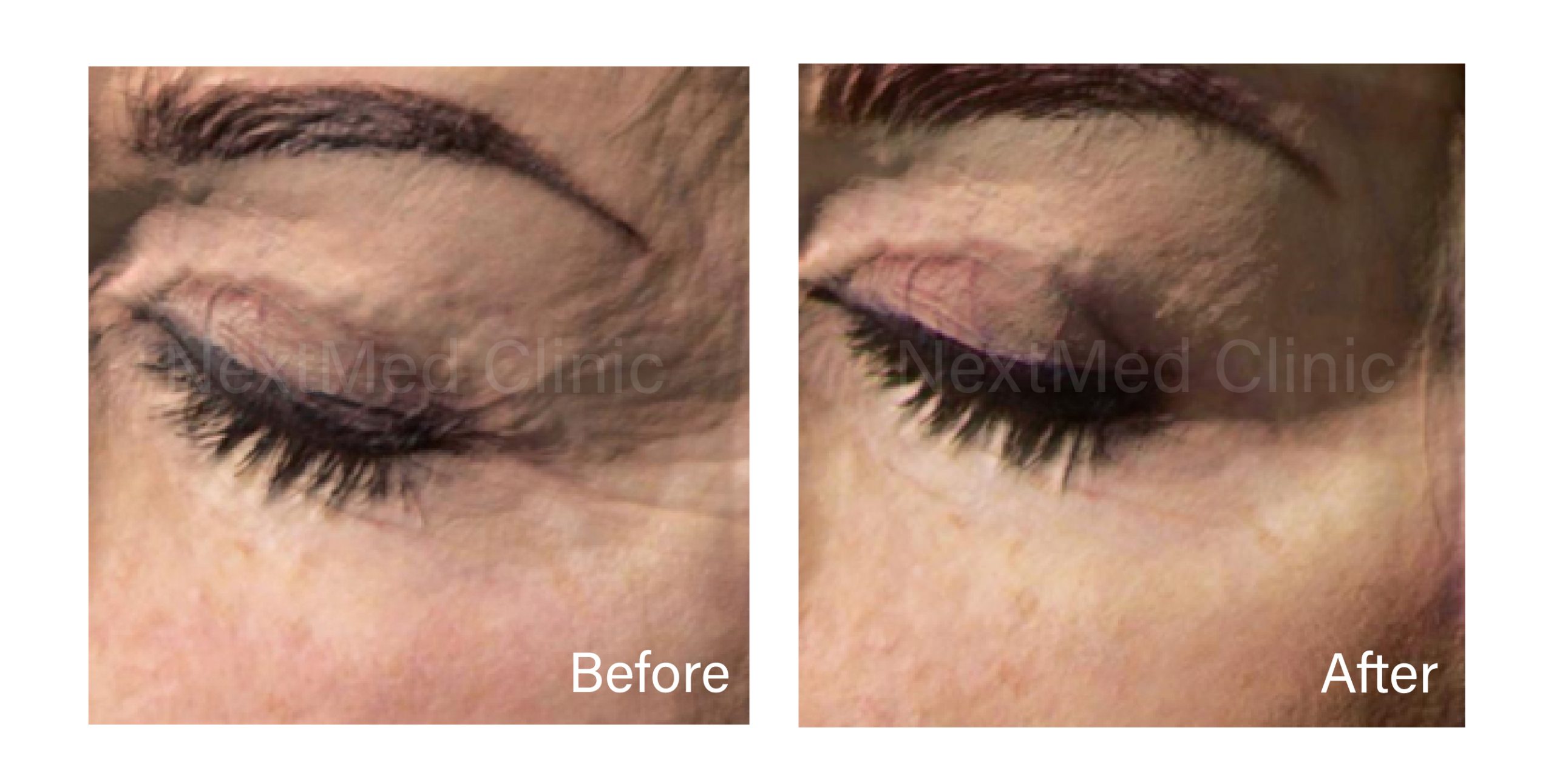 Best Plinest Treatment in Malaysia - NextMed Clinic