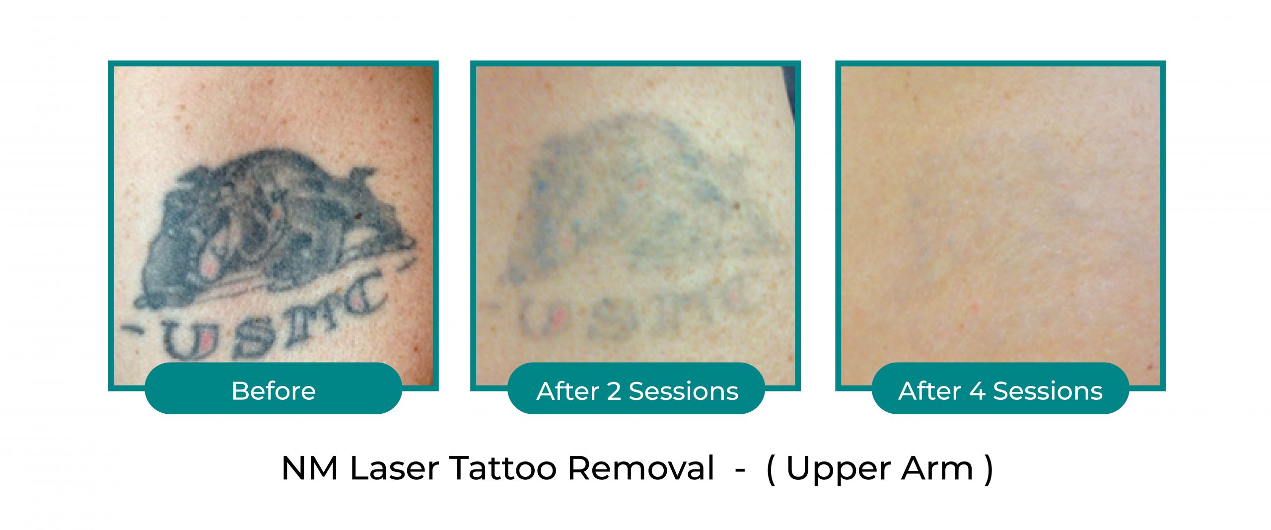 Best Tattoo Removal in Kuala Lumpur and Selangor - NextMed Clinic