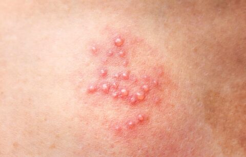 10 surprising symptoms of common STDs you should know about! - NextMed ...