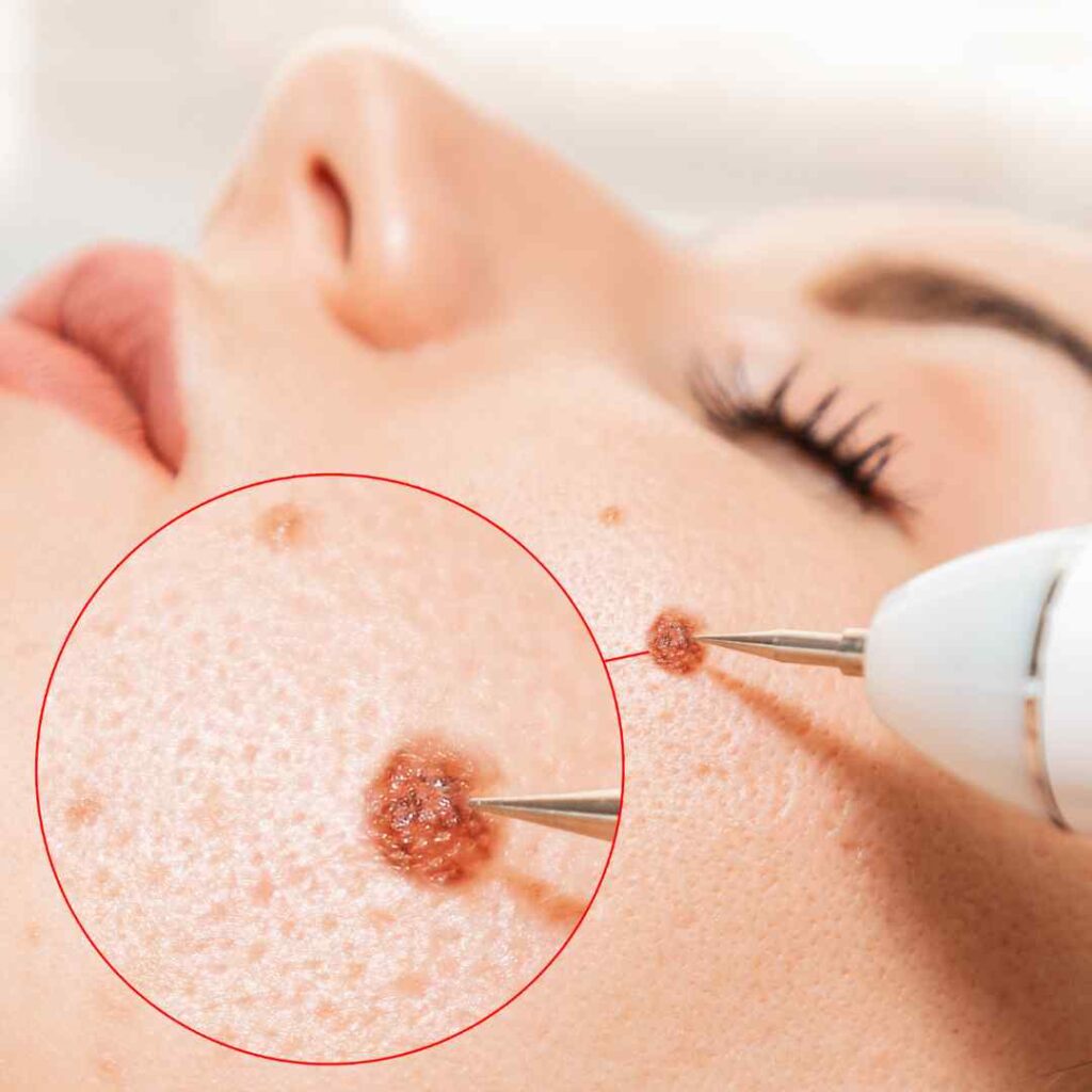 pigmentation