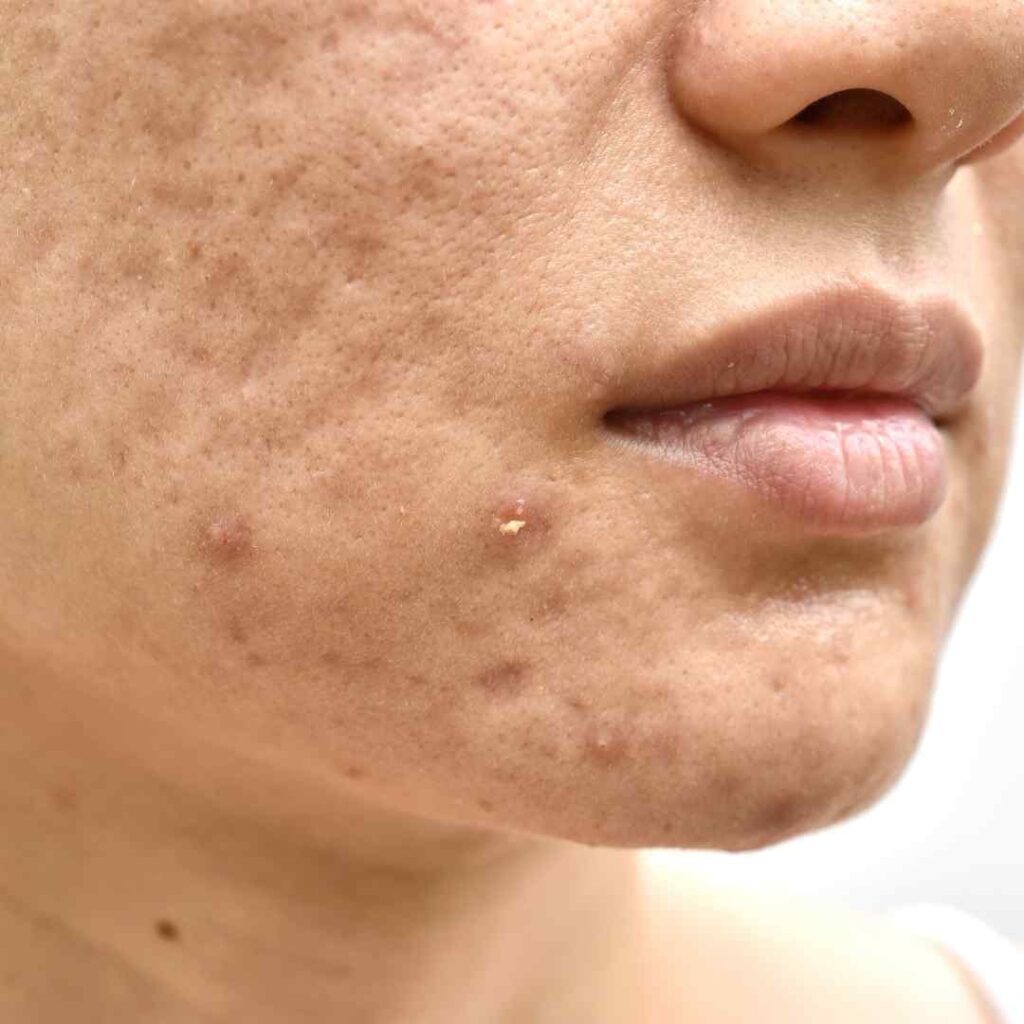acne scar