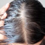 hair loss