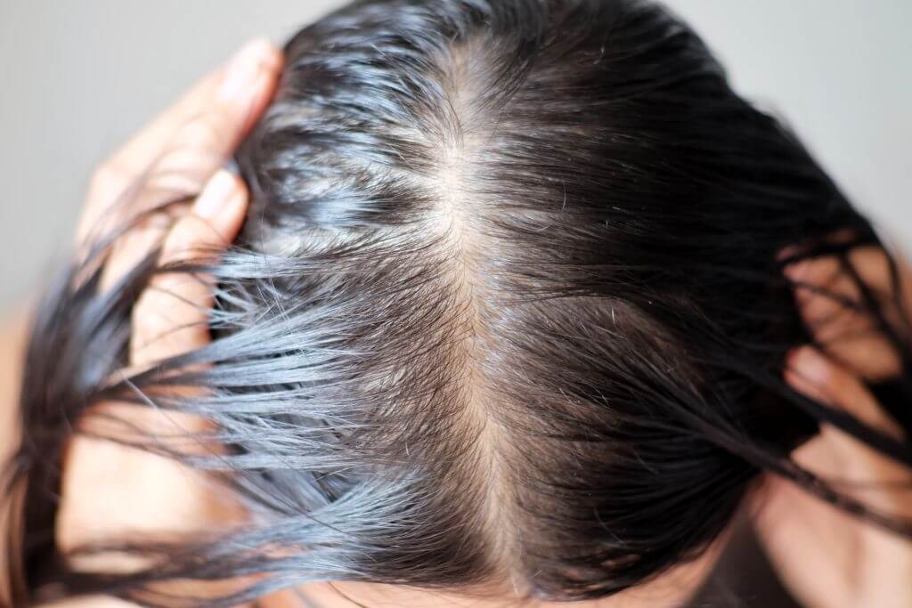 hair loss