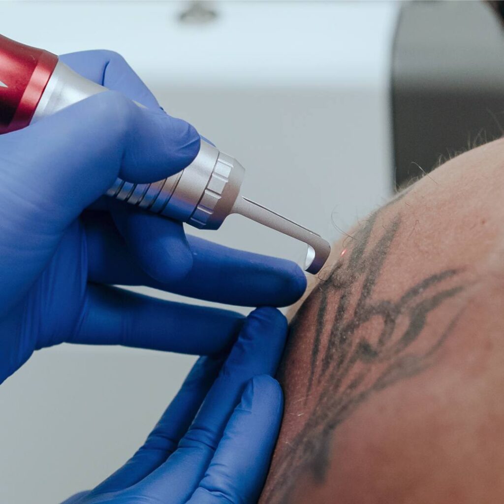 laser tattoo removal