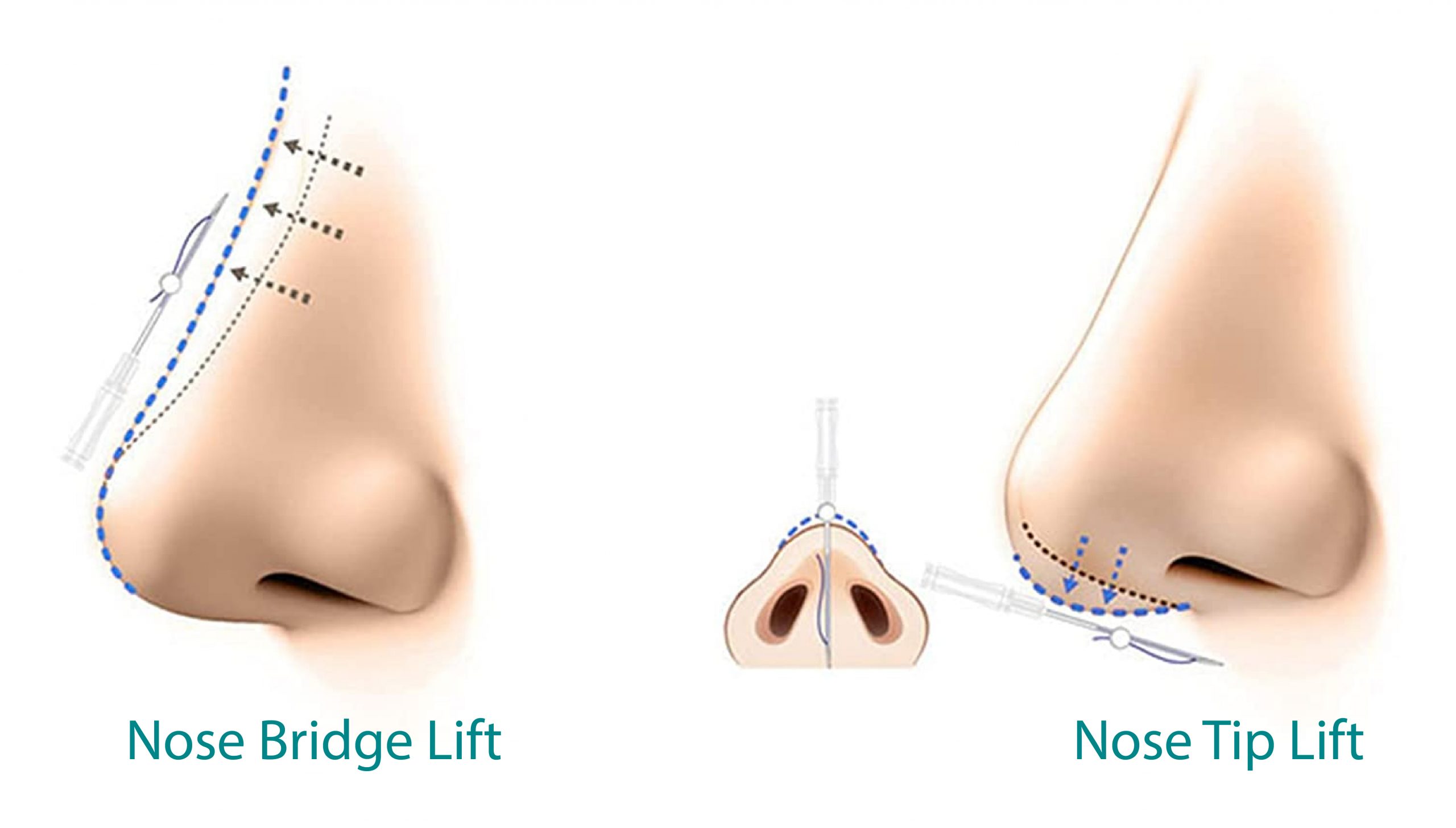 NOSE-15-scaled.jpg NOSE-15-scaled.jpg