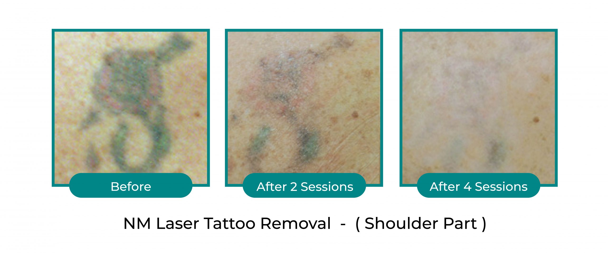 NextMed-Laser-tattoo-before-after-official-2-scaled.jpg