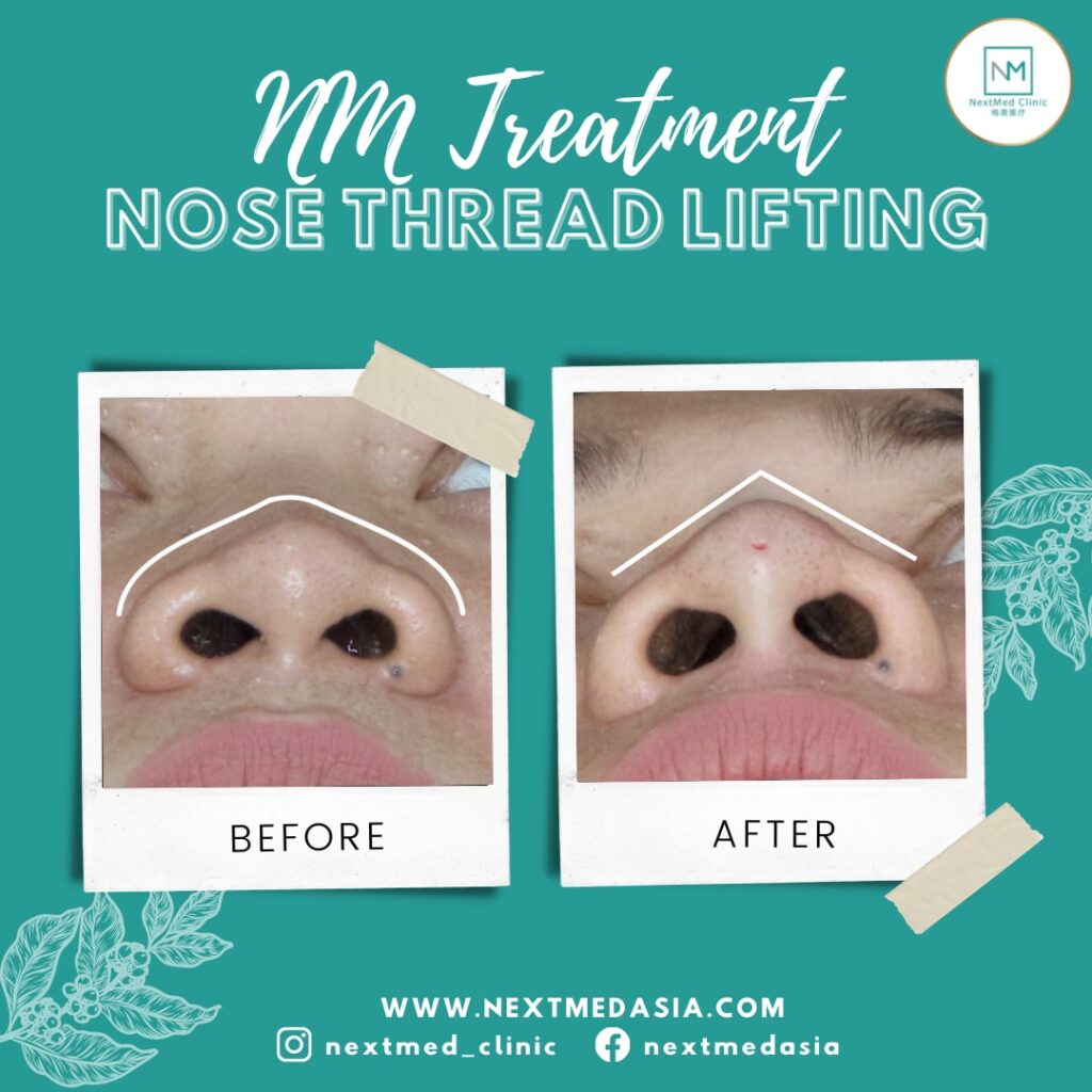 nose thread lift
