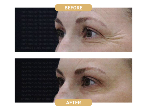 WRINKLE REDUCTION (1)