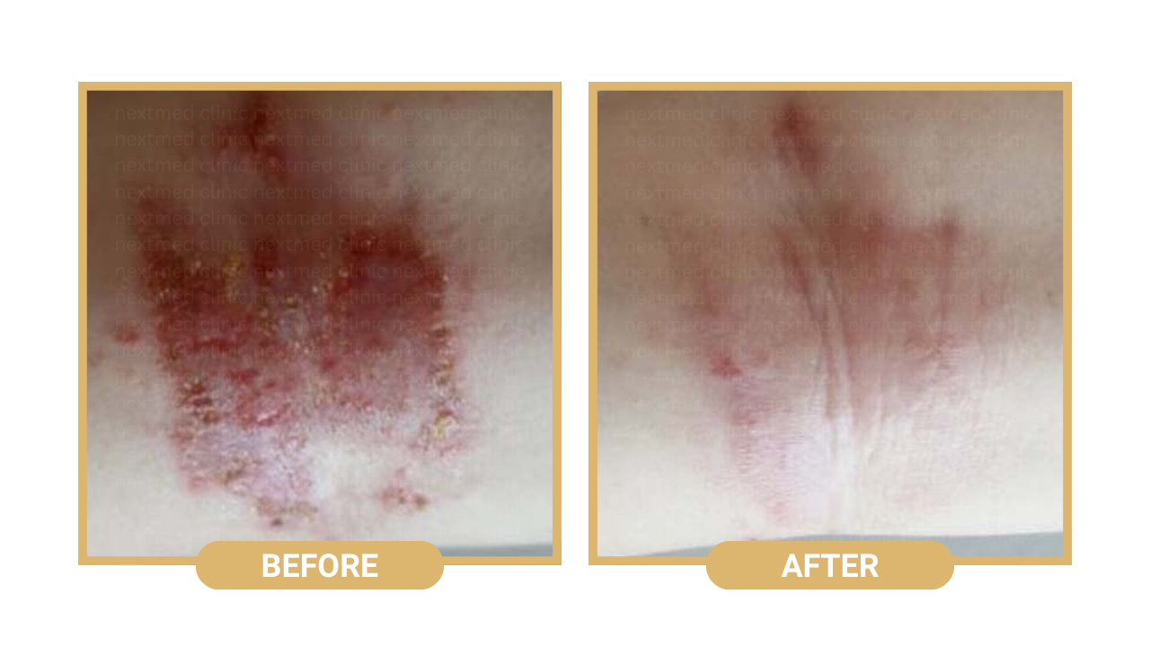 eczema before after (3)