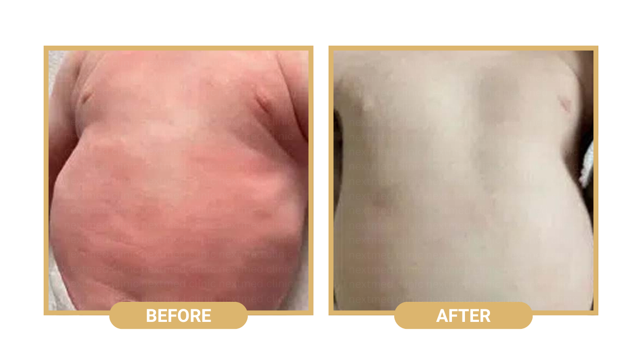 eczema