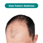hair loss
