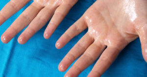 hyperhidrosis