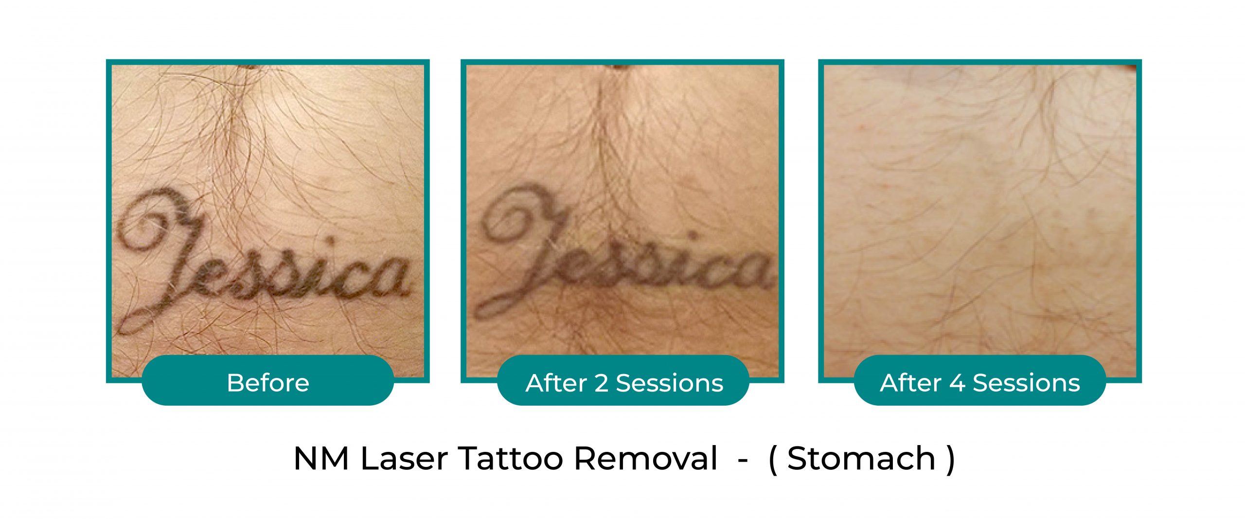 laser-tattoo-blog-09-scaled.jpg