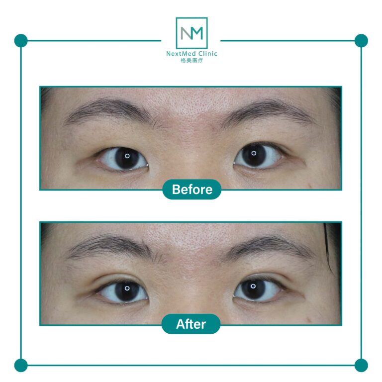 double eyelid suture