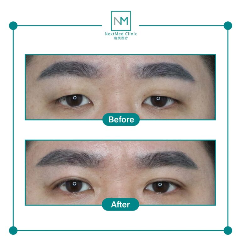 double eyelid suture