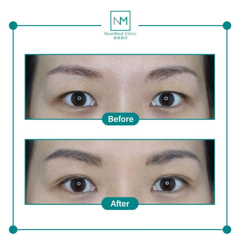 double eyelid suture