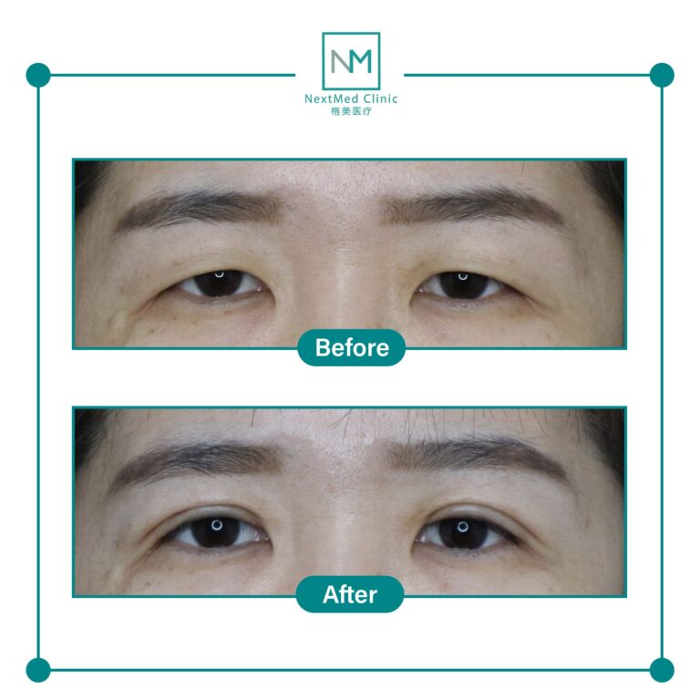 double eyelid suture