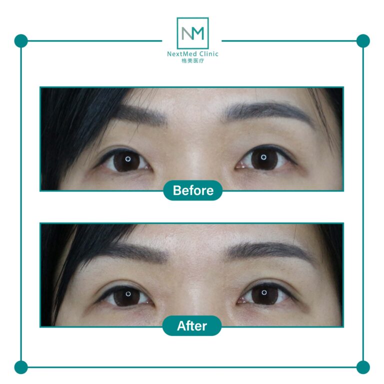 double eyelid suture