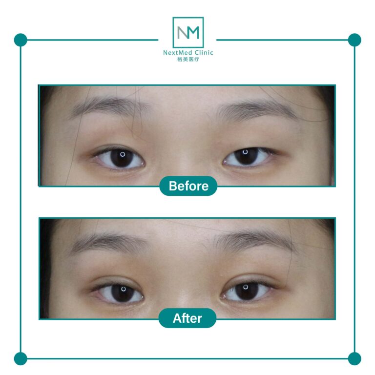double eyelid suture