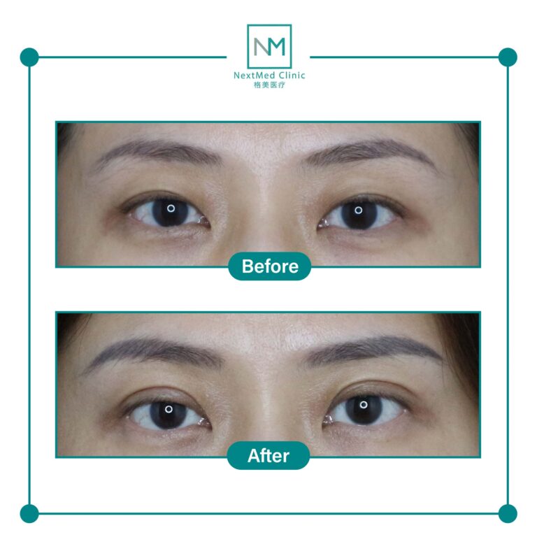 double eyelid suture