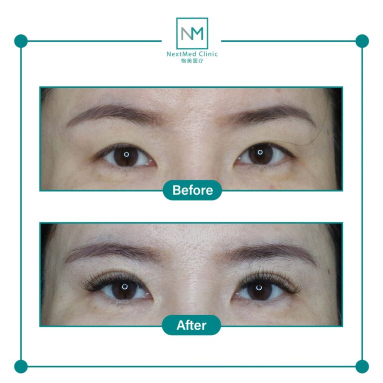 double eyelid suture