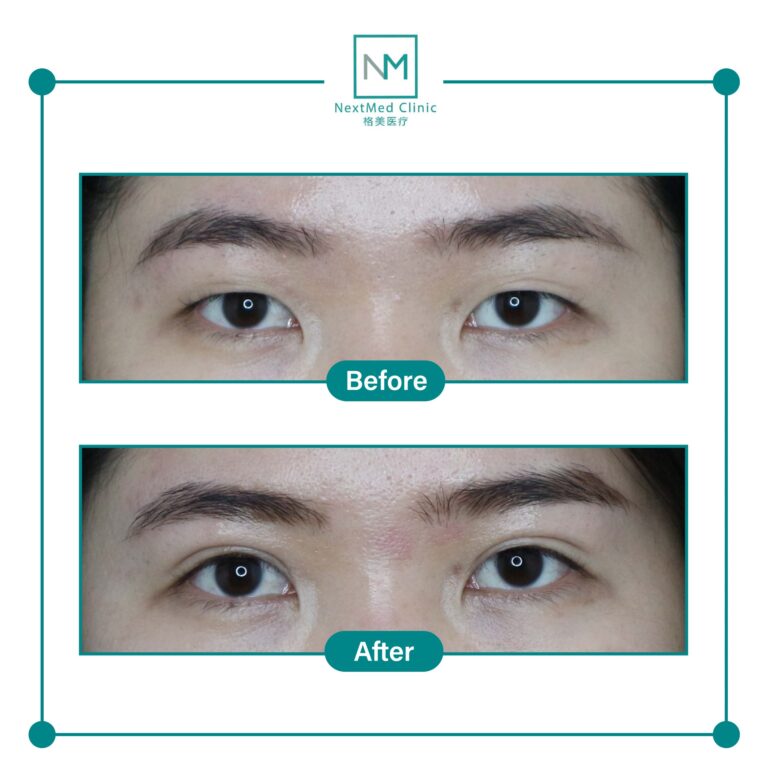 double eyelid suture