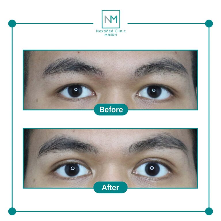 double eyelid suture
