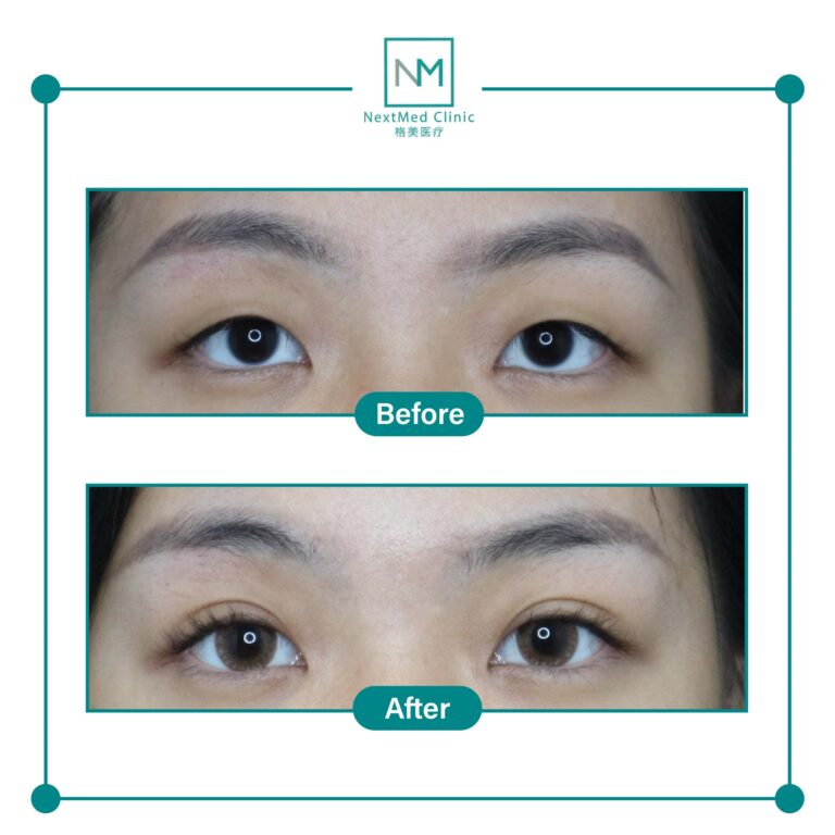 double eyelid suture