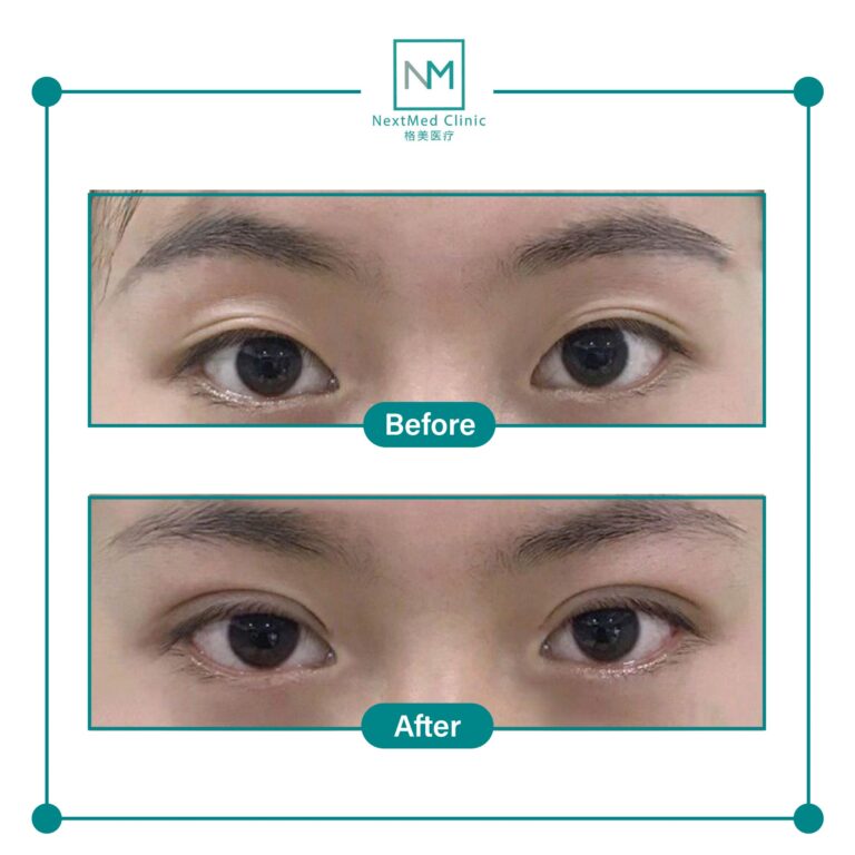 double eyelid suture