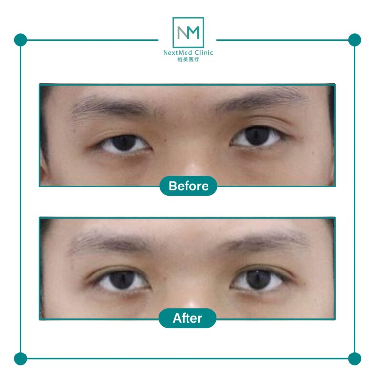 double eyelid suture