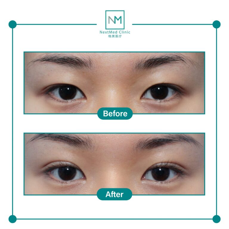 double eyelid suture