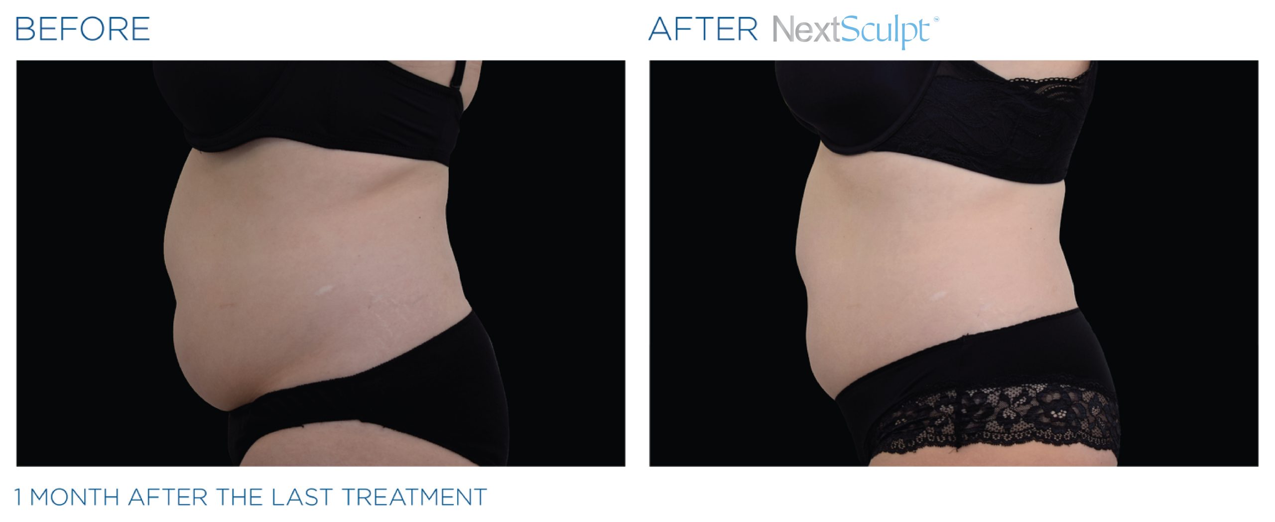 nextsculpt-before-after-03-scaled.jpg