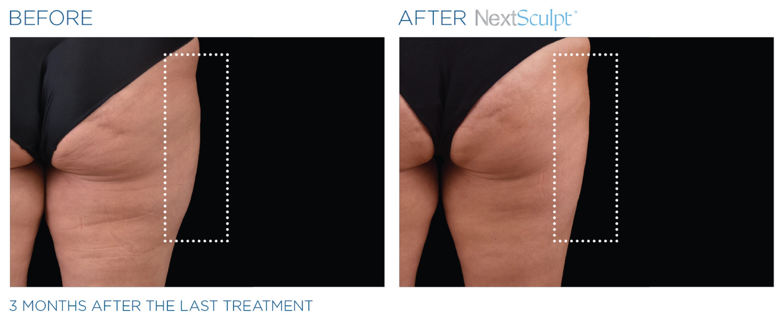 nextsculpt-before-after-07-scaled.jpg