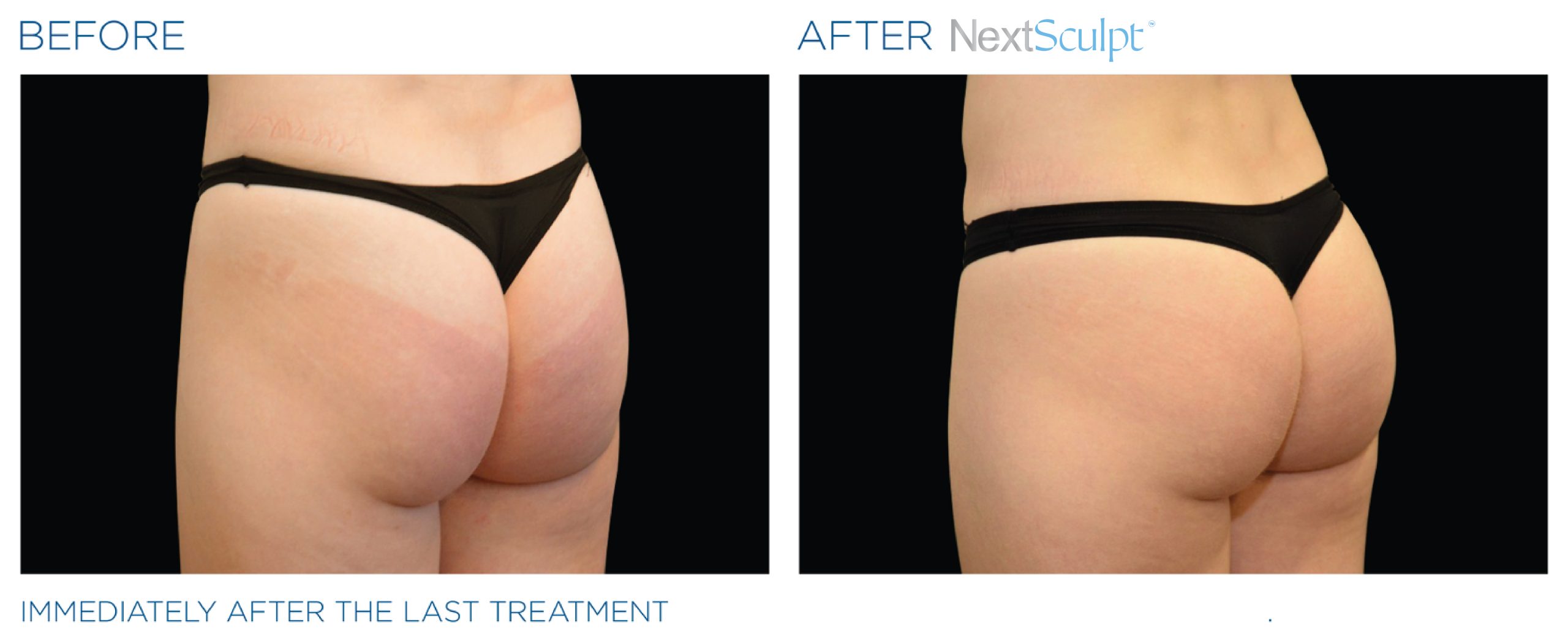 nextsculpt-before-after-11-scaled.jpg