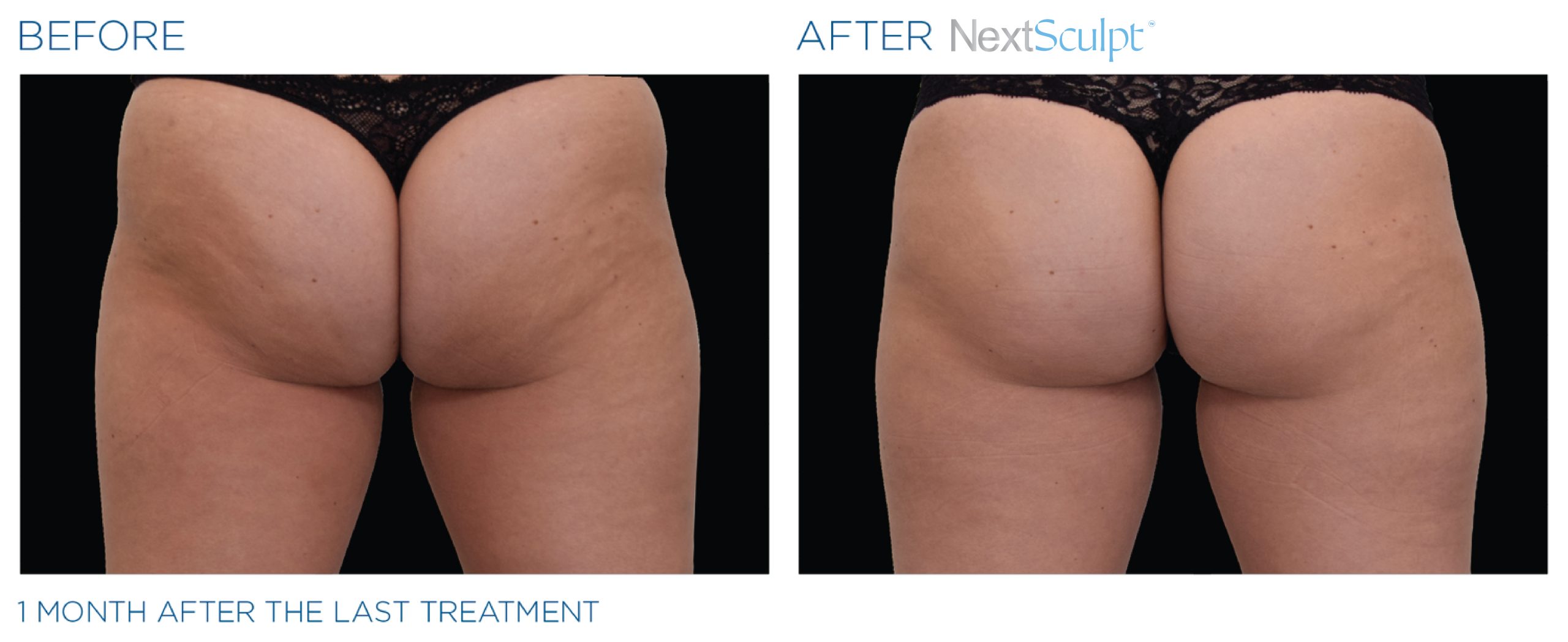 nextsculpt-before-after-12-scaled.jpg