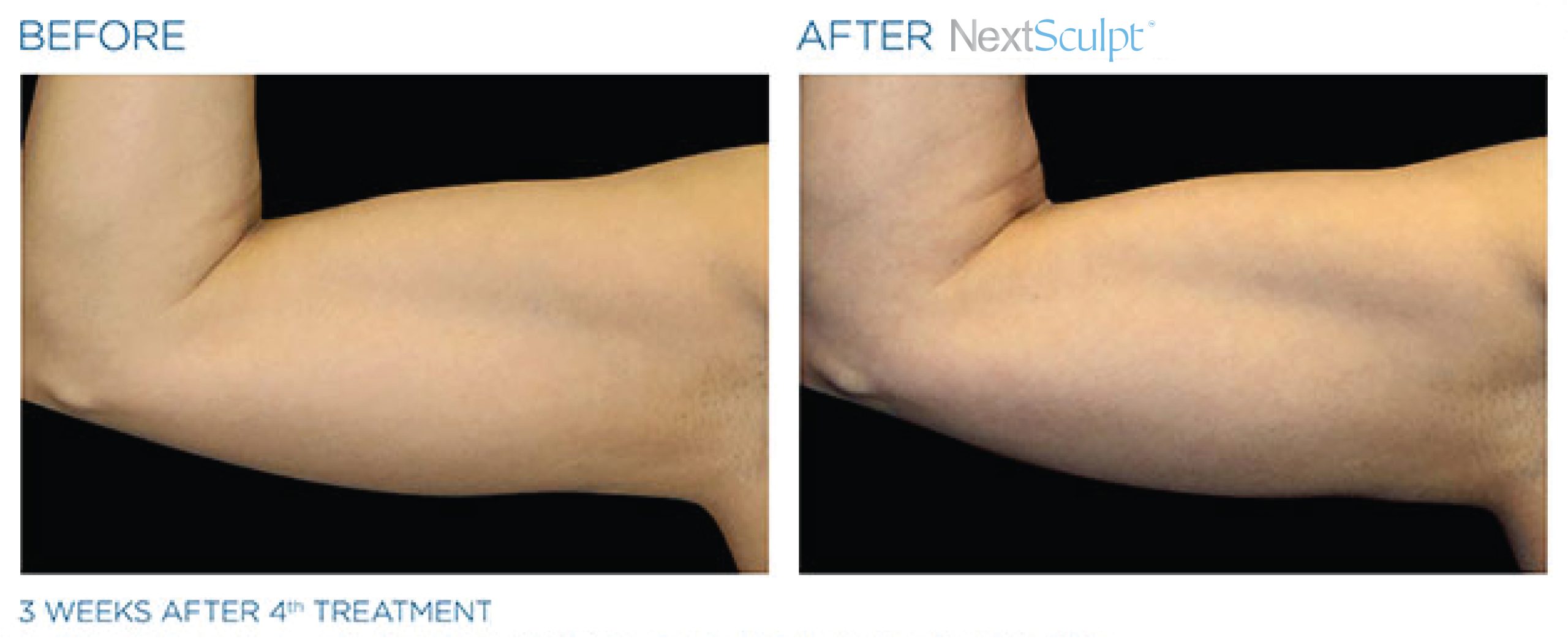 nextsculpt-before-after-14-scaled.jpg