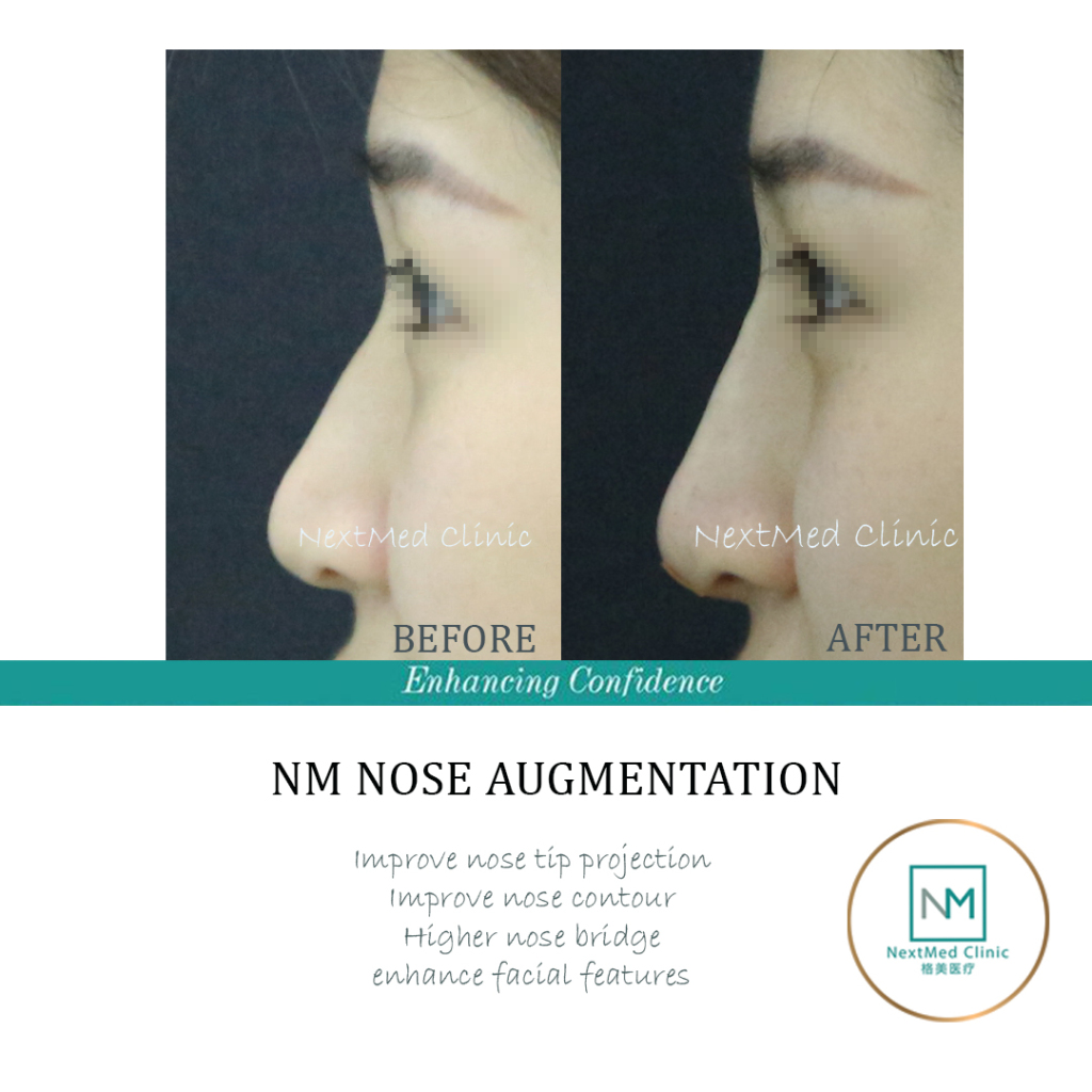 nose-augmentation-5.jpg