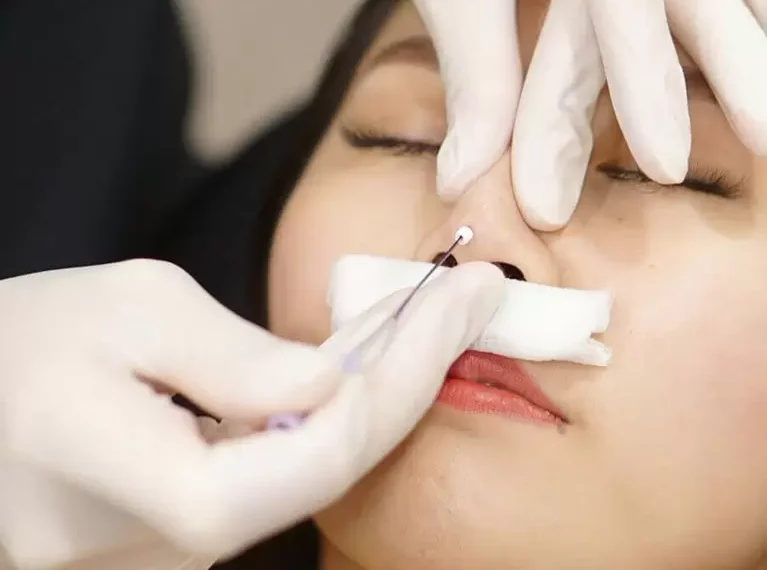 Nose thread