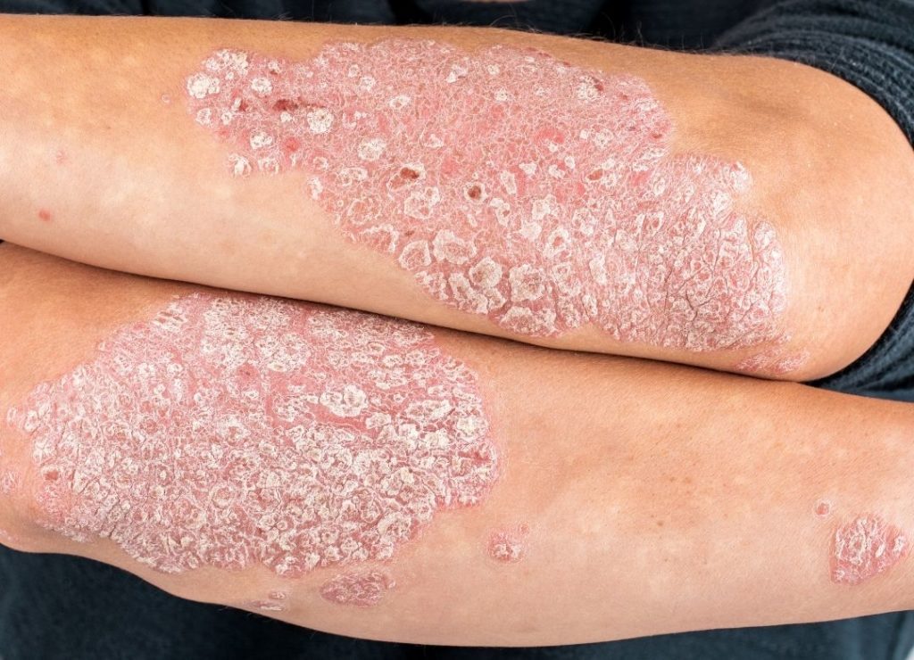 eczema