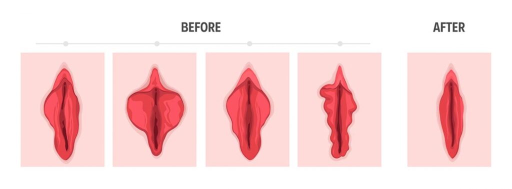 vaginal rejuvenation