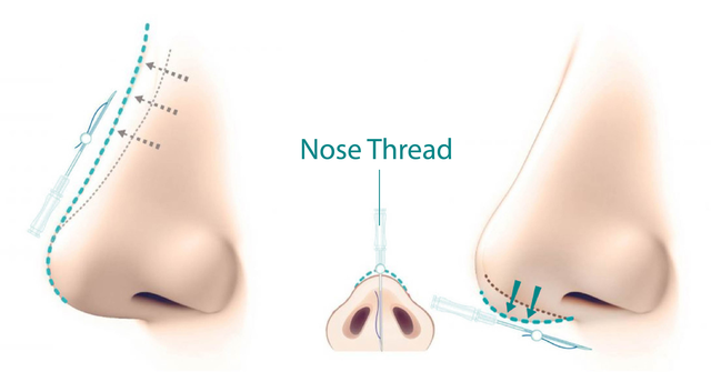 nose thread