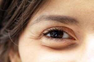 double eyelid