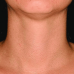 NECK REJUVENATION