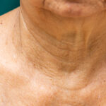 NECK REJUVENATION