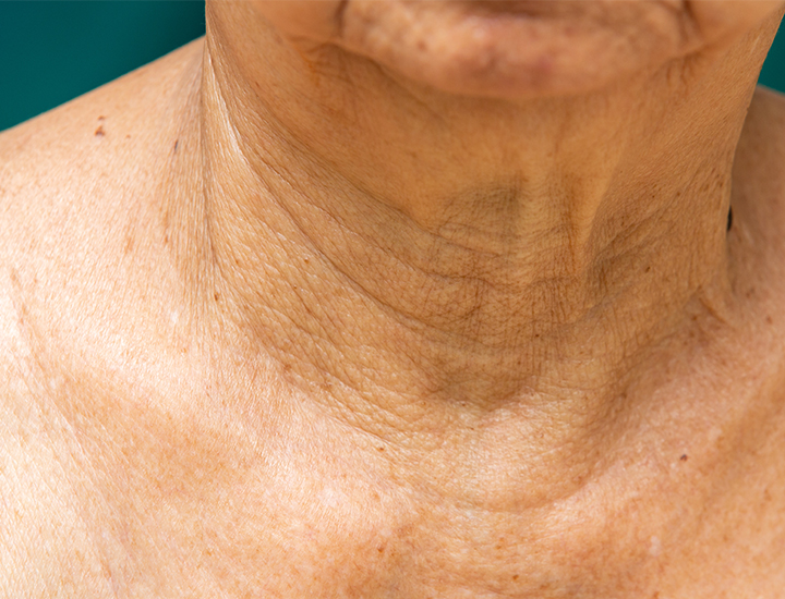 NECK REJUVENATION