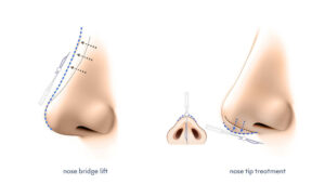 nose thread