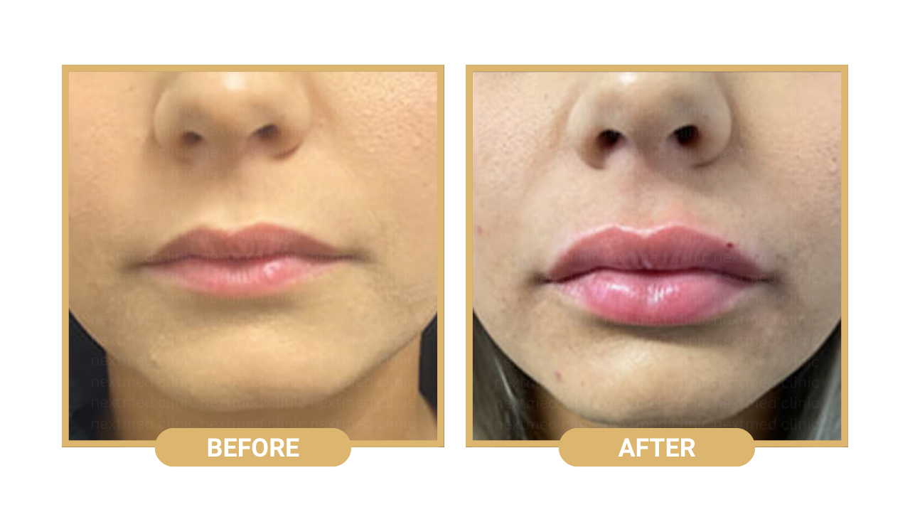 lip filler nextmed before after (1)