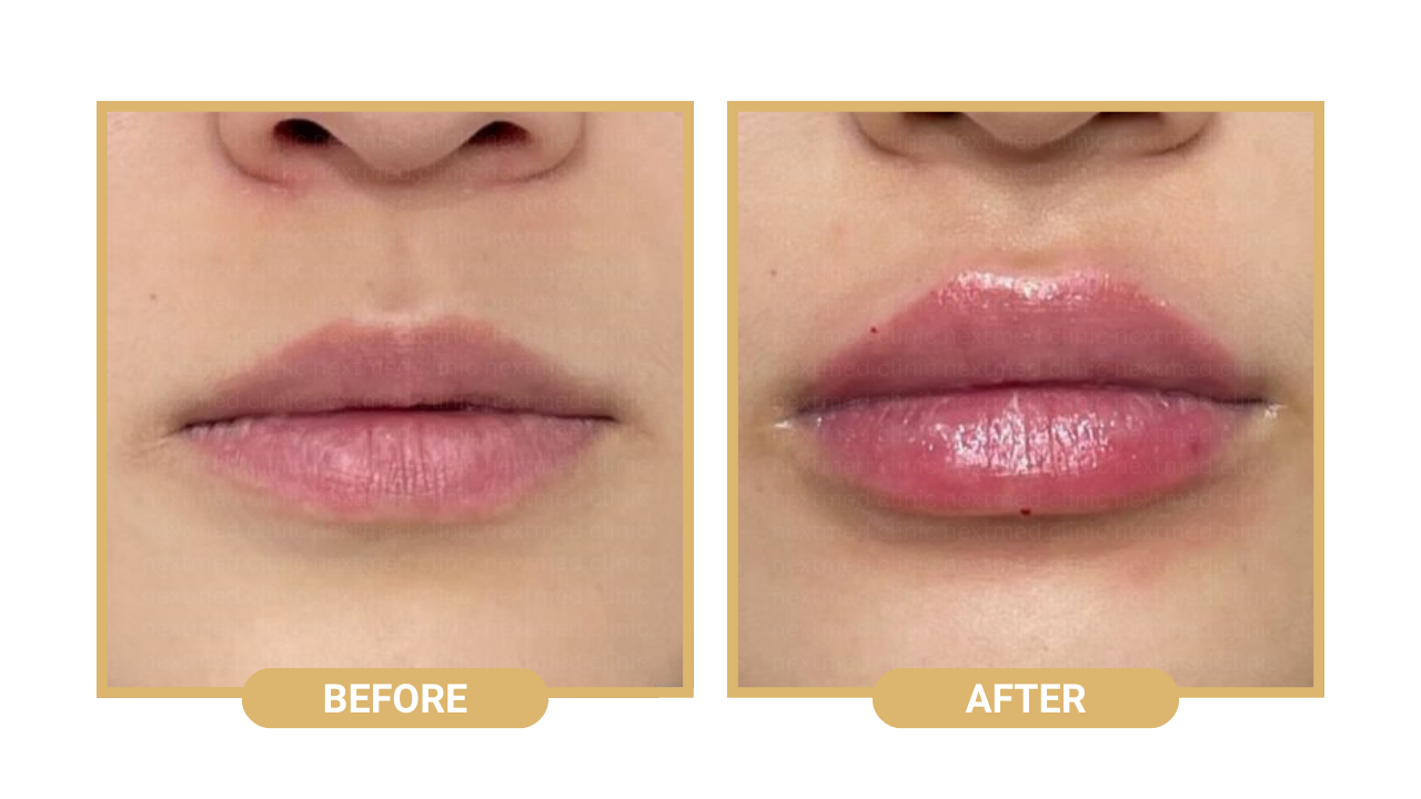 lip filler nextmed before after (2)