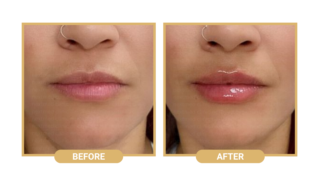 lip filler nextmed before after (3)