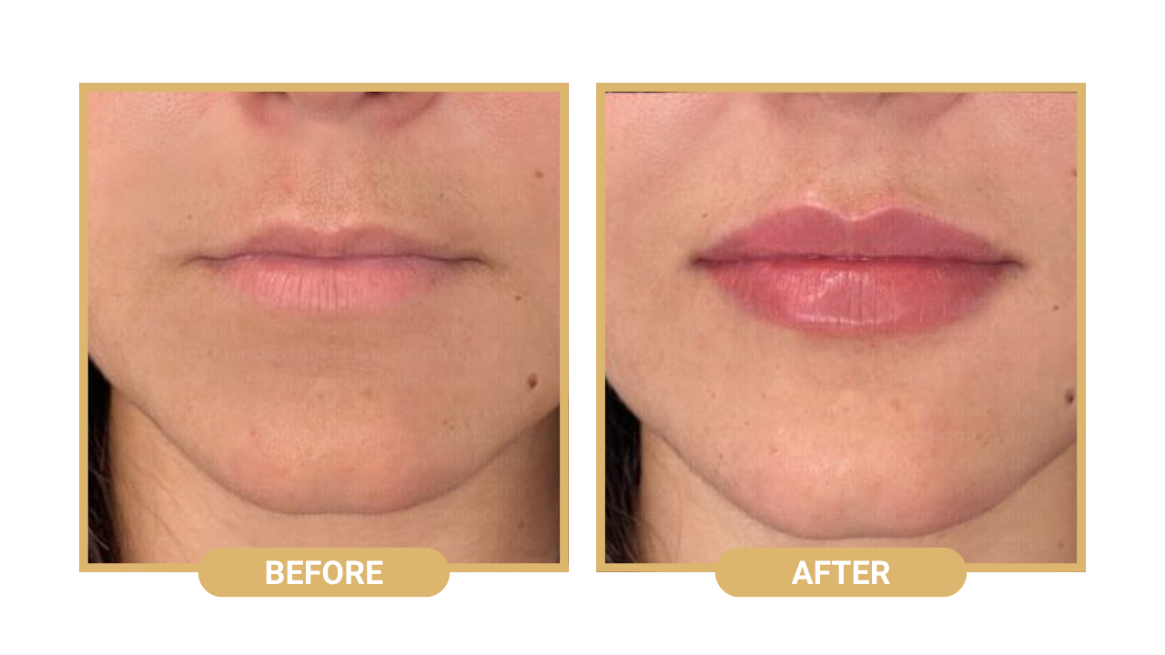 lip filler nextmed before after (4)